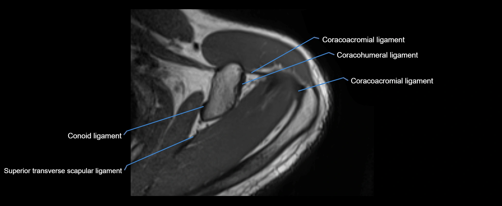 shoulder ligaments axial 3d 3t mri image-img-00005-00036.webp